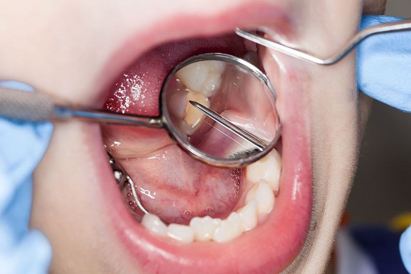 caries dentaire dentiste drummondville