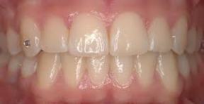 Clinique-Familiale-Dentaire-Drummondville_dentistes_4-1-Orthodontie-malocclusion