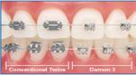 Clinique-Familiale-Dentaire-Drummondville_dentistes_4-6-Types-dappareil