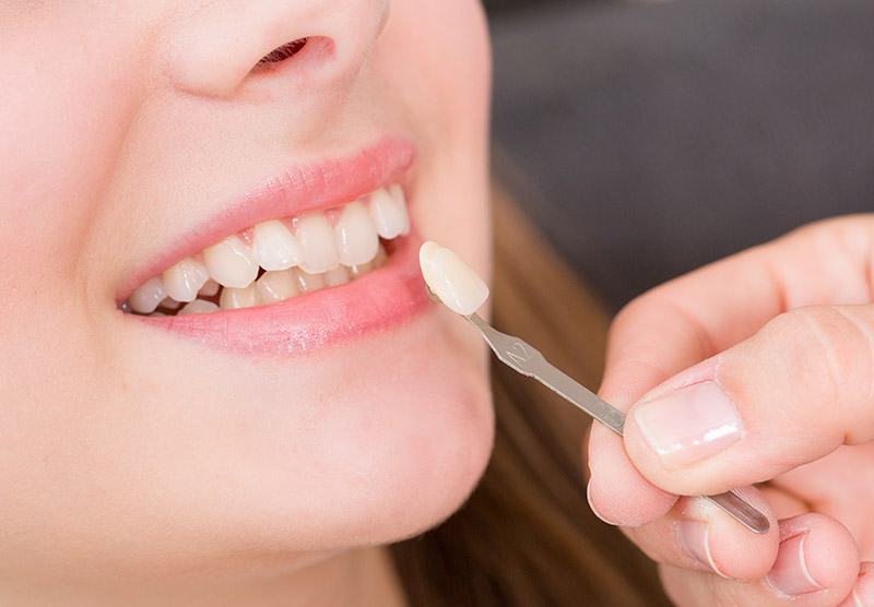 facette dentaire dentiste drummondville