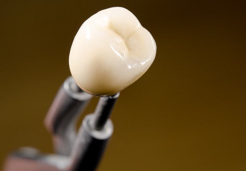 couronne dentaire dentiste drummondville