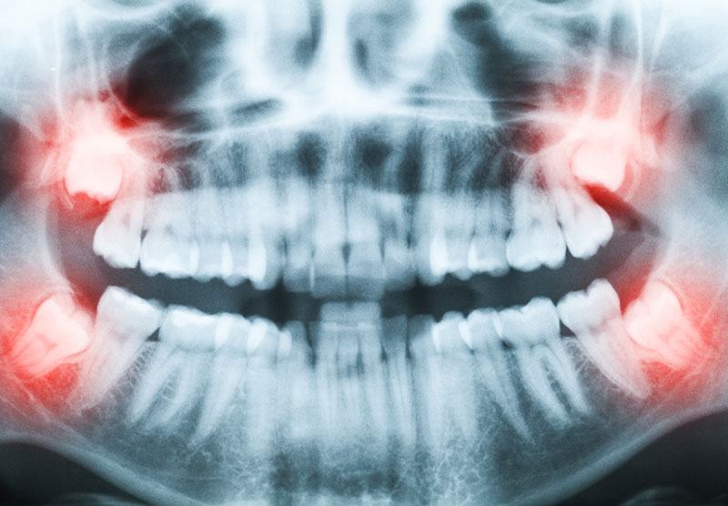 dents de sagesses dentiste drummondville