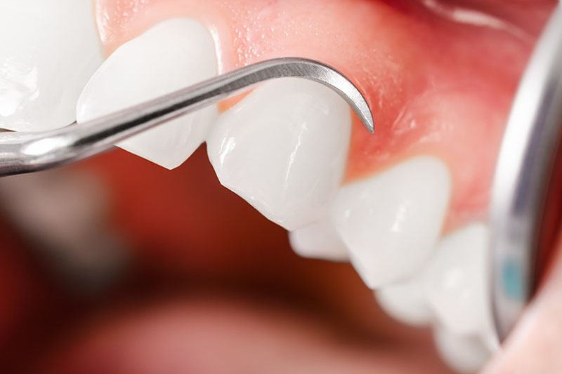 parodontie gencive dentiste drummondville