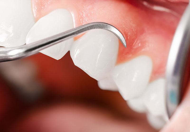 parodontie gencive dentiste drummondville