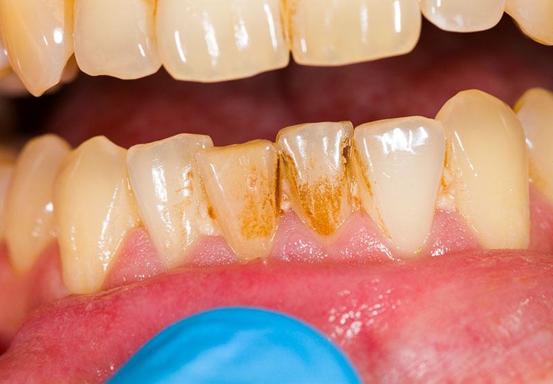 tabagisme dentiste drummondville